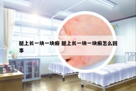 腿上长一块一块癣 腿上长一块一块癣怎么回事