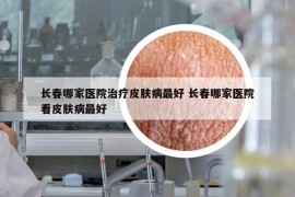 长春哪家医院治疗皮肤病最好 长春哪家医院看皮肤病最好