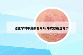 达克宁对牛皮癣有用吗 牛皮肤癣达克宁