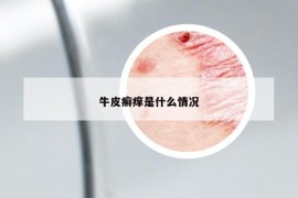 牛皮癣痒是什么情况