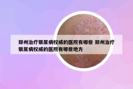 郑州治疗银屑病权威的医院有哪些 郑州治疗银屑病权威的医院有哪些地方