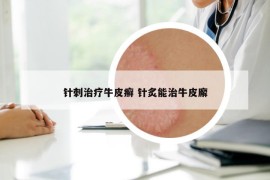 针刺治疗牛皮癣 针炙能治牛皮廨