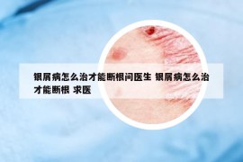 银屑病怎么治才能断根问医生 银屑病怎么治才能断根 求医