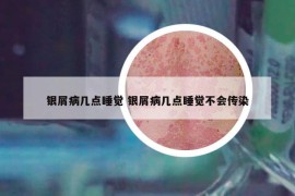 银屑病几点睡觉 银屑病几点睡觉不会传染