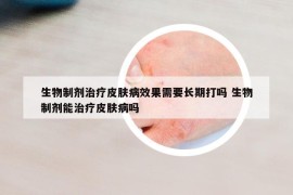 生物制剂治疗皮肤病效果需要长期打吗 生物制剂能治疗皮肤病吗