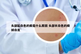 头部起白色的癣是什么原因 头部长白色的癣掉白皮