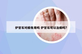 炉甘石对癣有用吗 炉甘石可以治癣吗?