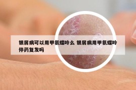 银屑病可以用甲氨蝶呤么 银屑病用甲氨蝶呤停药复发吗