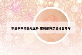 银屑病突然蔓延全身 银屑病突然蔓延全身痒