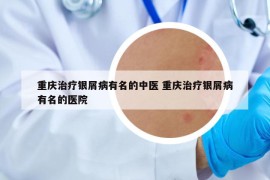 重庆治疗银屑病有名的中医 重庆治疗银屑病有名的医院