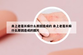 身上老是长癣什么原因造成的 身上老是长癣什么原因造成的图片