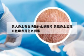 男人身上有白块是什么病图片 男性身上出现白色斑点是怎么回事