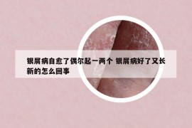 银屑病自愈了偶尔起一两个 银屑病好了又长新的怎么回事