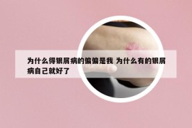 为什么得银屑病的偏偏是我 为什么有的银屑病自己就好了