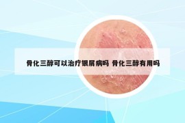 骨化三醇可以治疗银屑病吗 骨化三醇有用吗