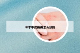 冬季牛皮癣要怎么预防