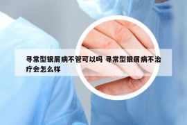 寻常型银屑病不管可以吗 寻常型银屑病不治疗会怎么样