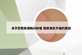 关节型银屑病胸闷肿痛 银屑病关节痛的原因