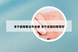 阜宁县哪里治牛皮癣 阜宁皮肤科哪家好