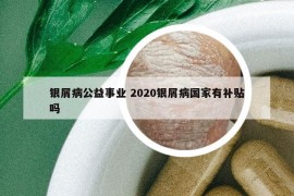 银屑病公益事业 2020银屑病国家有补贴吗