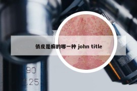 俏皮是癣的哪一种 john title