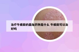 治疗牛疲藓的最加药物是什么 牛疲藓可以治好吗