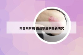 南昌银屑病 南昌银屑病最新研究