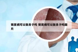 银屑病可以做鼻子吗 银屑病可以做鼻子吗图片