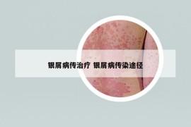 银屑病传治疗 银屑病传染途径