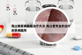 海口银屑病最新治疗方法 海口更专业的治疗皮肤病医院