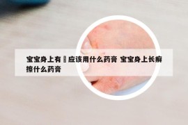 宝宝身上有廯应该用什么药膏 宝宝身上长癣擦什么药膏