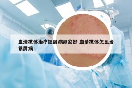 血清抗体治疗银屑病那家好 血清抗体怎么治银屑病