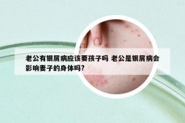 老公有银屑病应该要孩子吗 老公是银屑病会影响妻子的身体吗?