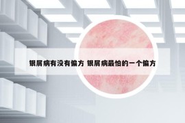 银屑病有没有偏方 银屑病最怕的一个偏方