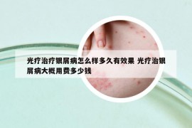 光疗治疗银屑病怎么样多久有效果 光疗治银屑病大概用费多少钱