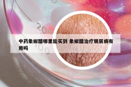 中药象椒醋哪里能买到 象椒醋治疗银屑病有用吗