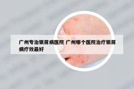 广州专治银屑病医院 广州哪个医院治疗银屑病疗效最好