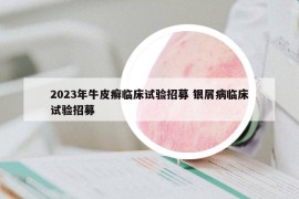 2023年牛皮癣临床试验招募 银屑病临床试验招募