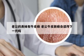 老公的表妹有牛皮癣 老公牛皮肤癣会遗传下一代吗