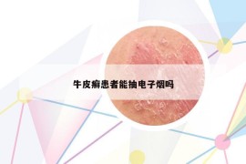 牛皮癣患者能抽电子烟吗