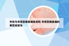 外伤与寻常型银屑病有关吗 寻常型银屑病的典型皮损为