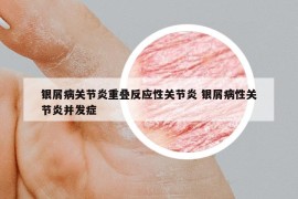 银屑病关节炎重叠反应性关节炎 银屑病性关节炎并发症