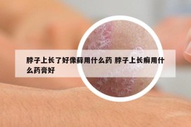 脖子上长了好像藓用什么药 脖子上长癣用什么药膏好