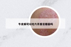 牛皮癣可以吃六月香豆瓣酱吗