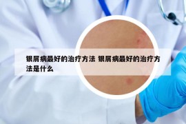 银屑病最好的治疗方法 银屑病最好的治疗方法是什么