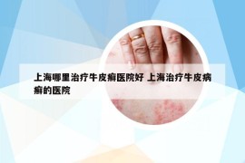 上海哪里治疗牛皮癣医院好 上海治疗牛皮病癣的医院