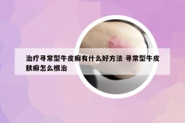 治疗寻常型牛皮癣有什么好方法 寻常型牛皮肤癣怎么根治