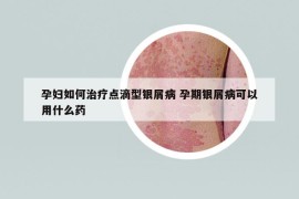 孕妇如何治疗点滴型银屑病 孕期银屑病可以用什么药