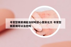 寻常型银屑病能治好吗舒心西安北方 寻常型银屑病可以治愈吗