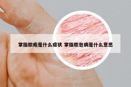 掌指脓疱是什么症状 掌指脓包病是什么意思